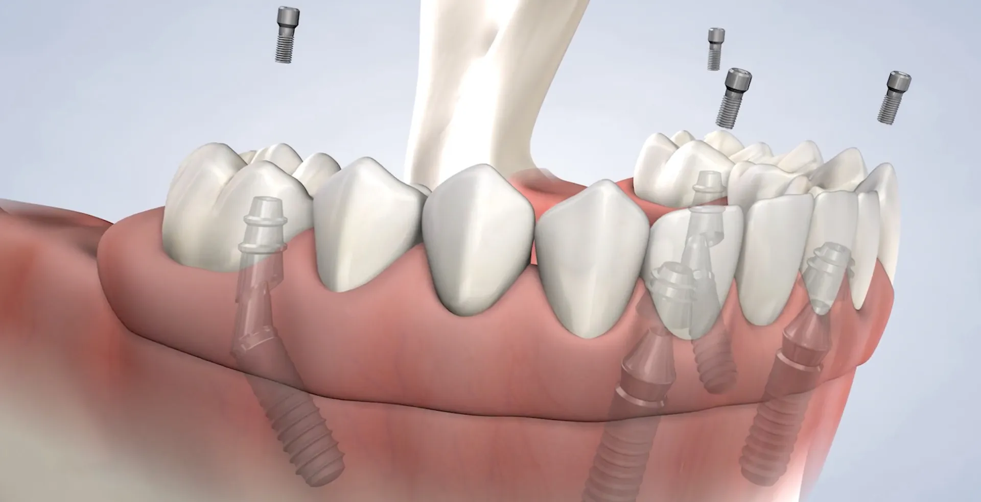 Full arch procedure what to0expect lifestyle