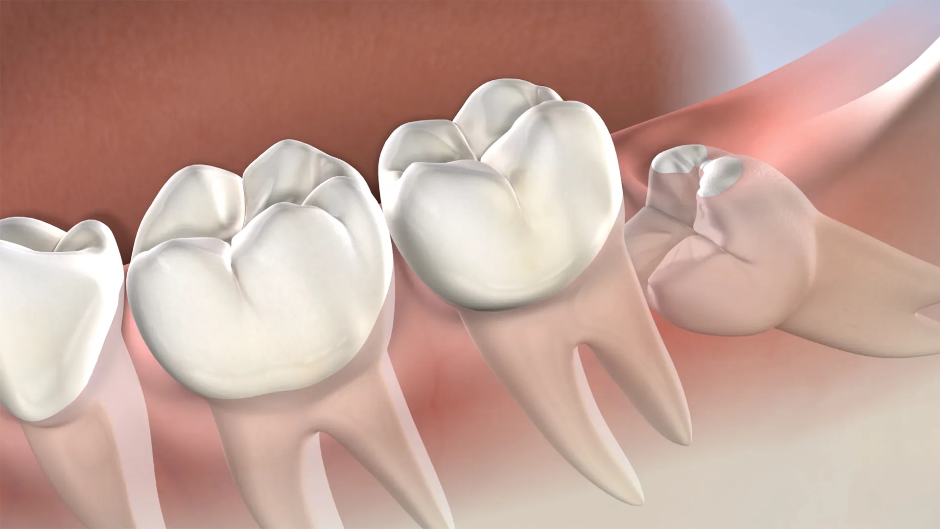 Wisdom Teeth Removal in Walnut Creek, CA