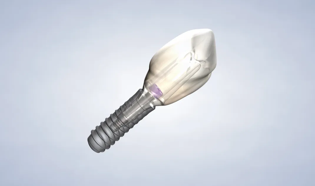 Lifestyle page dental implant image