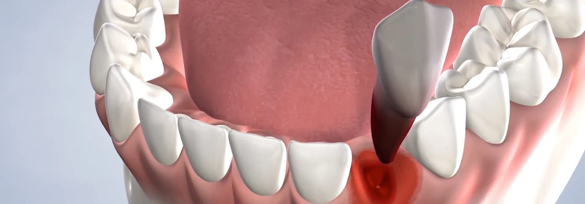Tooth Extractions in Walnut Creek, CA