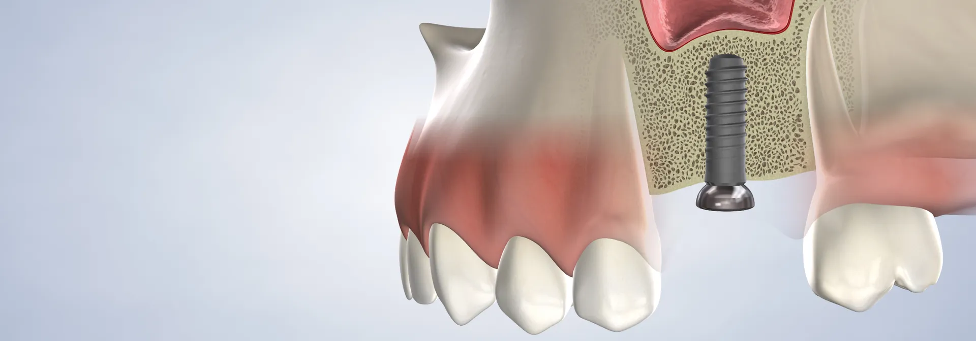 Bone Grafting in Walnut Creek, CA