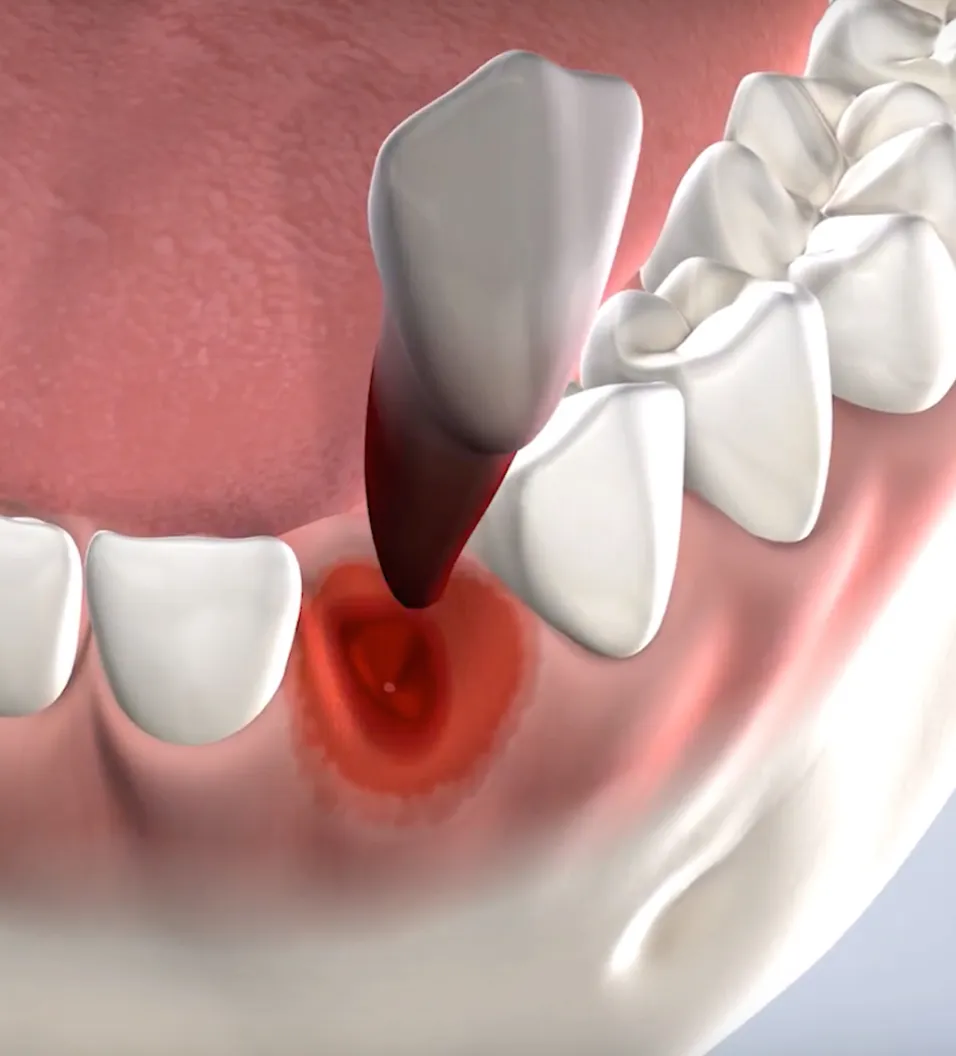 Tooth Extractions in Walnut Creek, CA