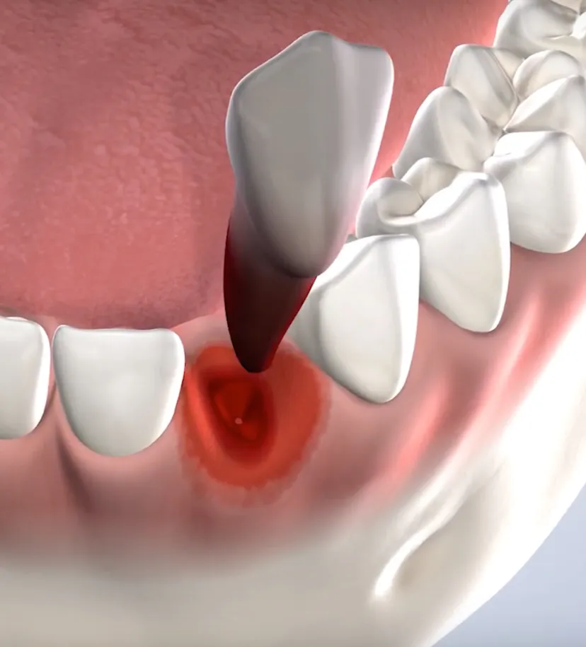 Tooth Extractions in Walnut Creek, CA