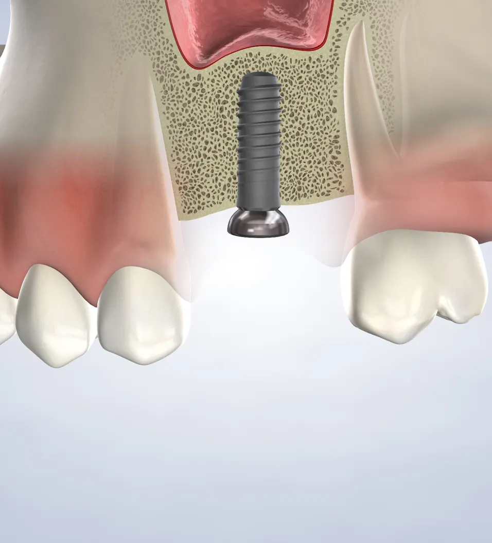 Bone Grafting in Walnut Creek, CA