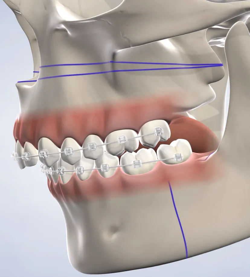 Orthognathic Surgery in Walnut Creek, CA