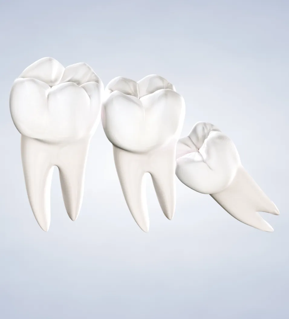 Impacted Wisdom Teeth Extractions in Walnut Creek, CA