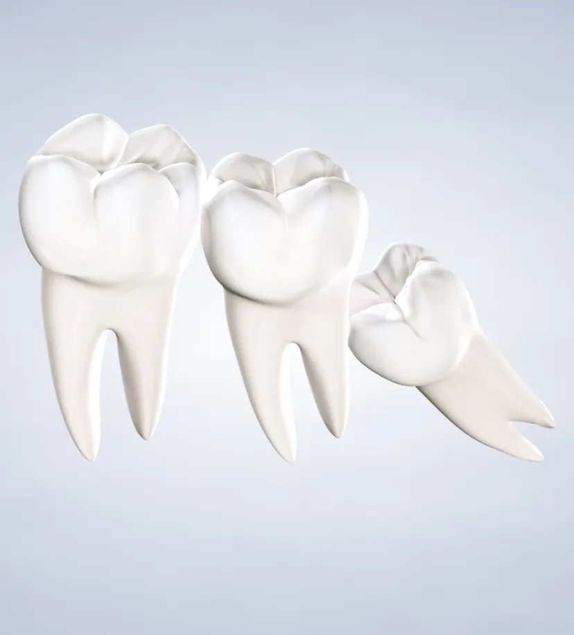 Impacted Wisdom Teeth Extractions in Walnut Creek, CA