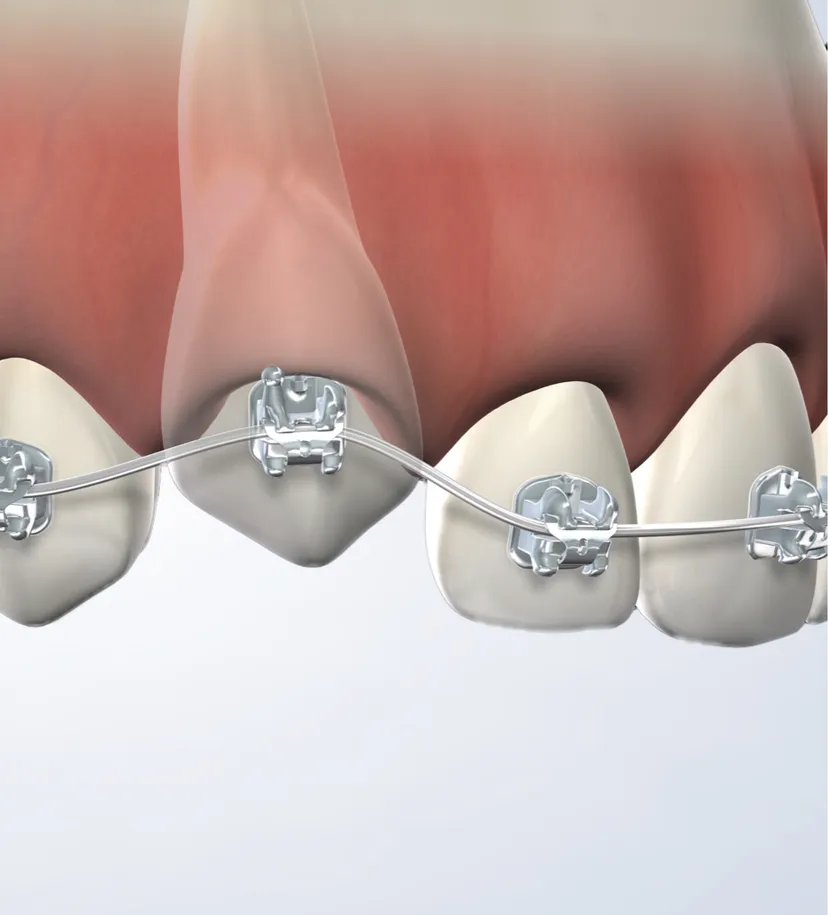 Impacted Canines Treatment in Walnut Creek, CA